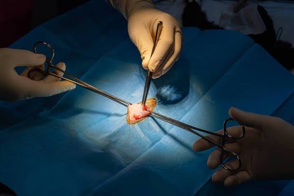 Explore appendix surgery